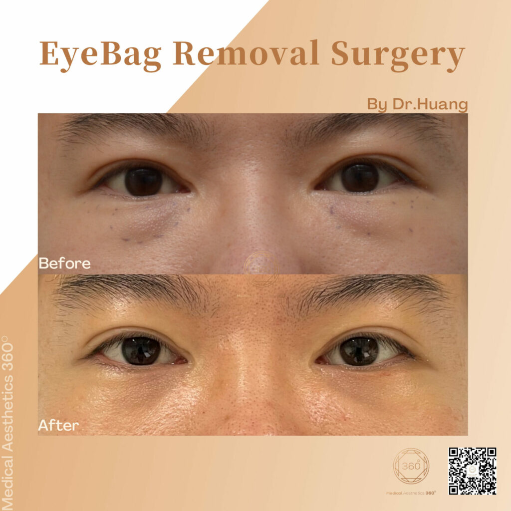 Best Eye Bag Removal Without Surgery – Cambridge Medical Group