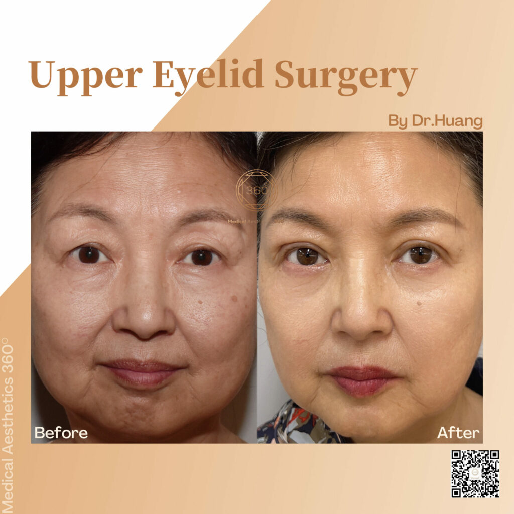 Upper Eyelid Surgery Before and After