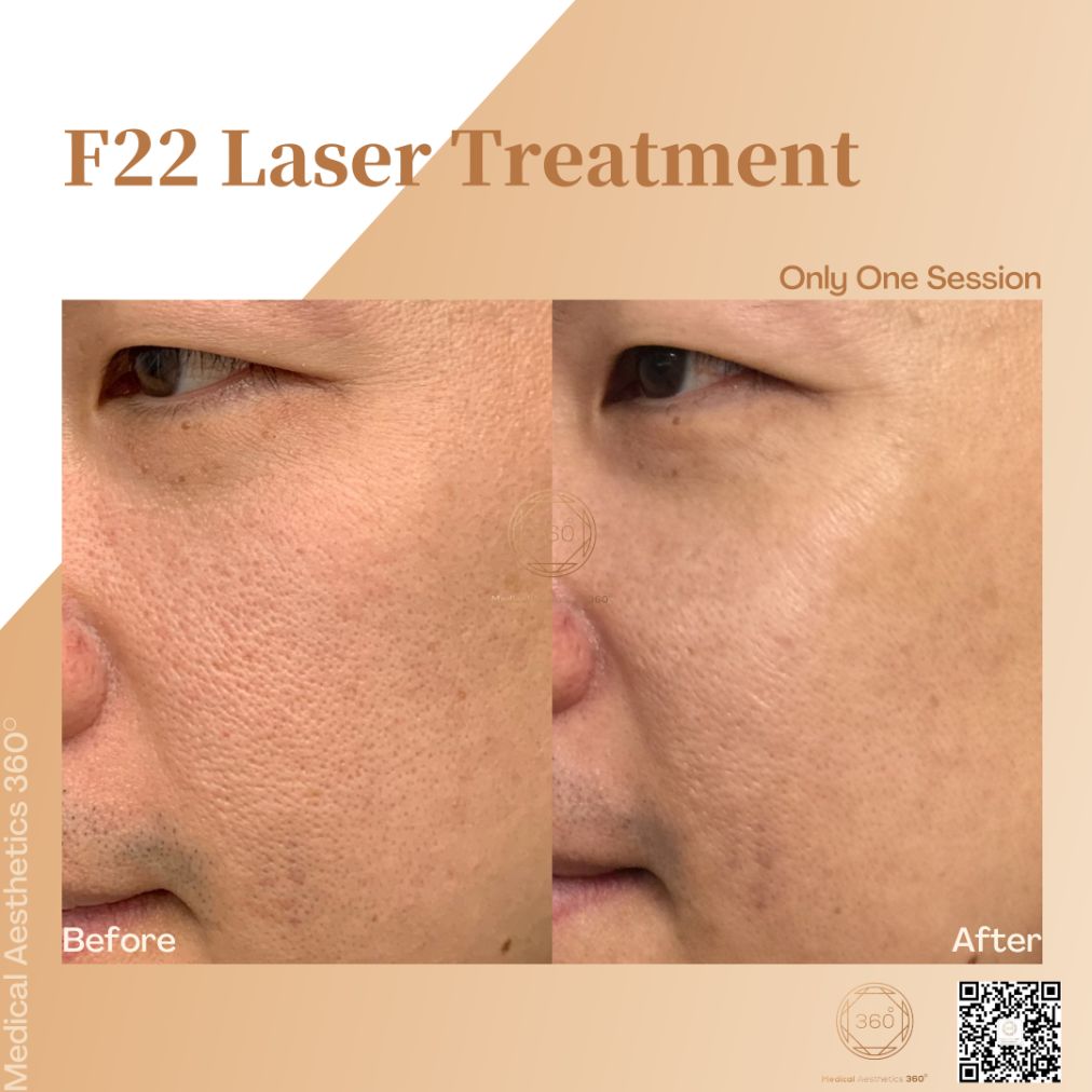 F22 Brady Laser Acne Scar Treatment Sydney