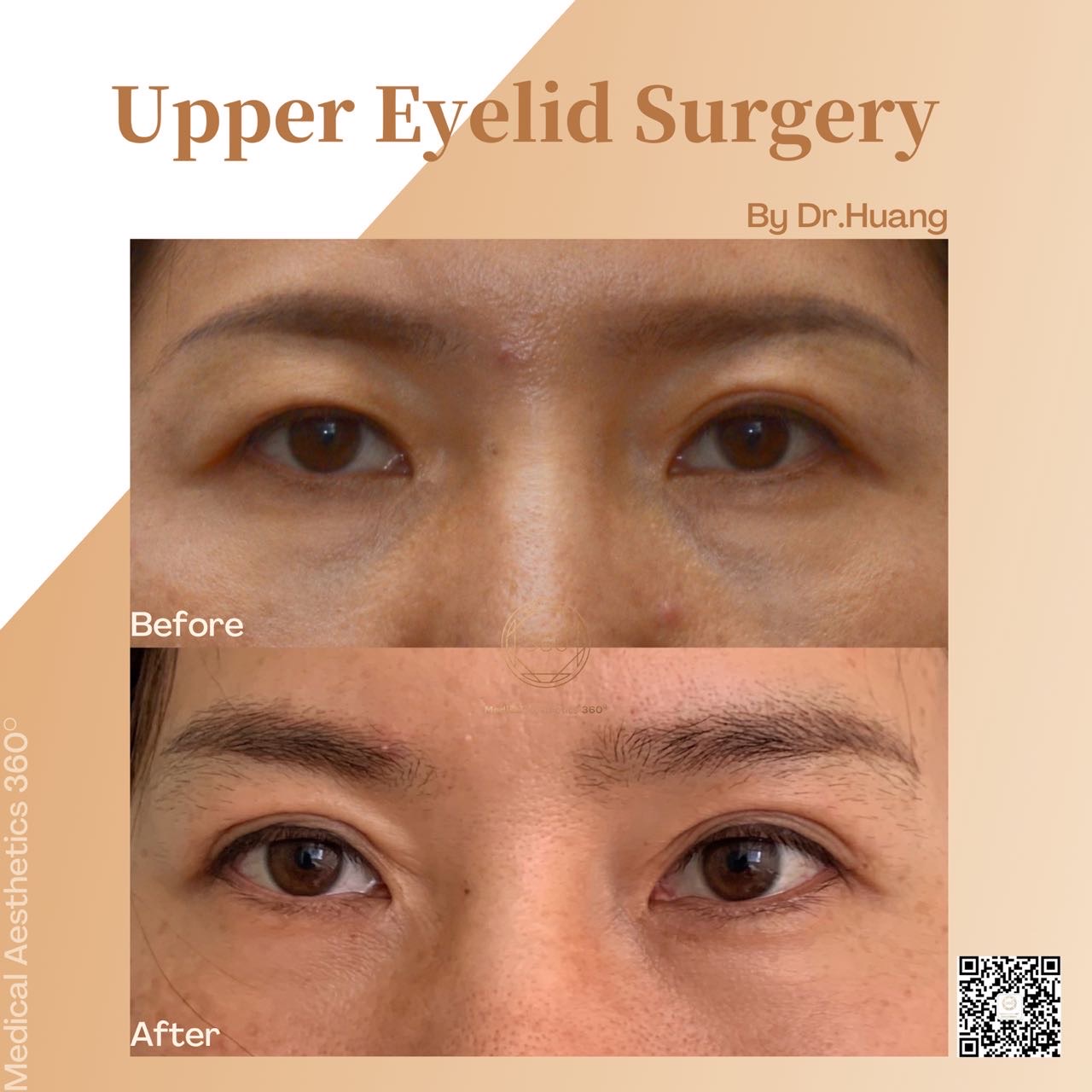 Blepharoplasty Medical Aesthetics 360° Chatswood Hurstville 