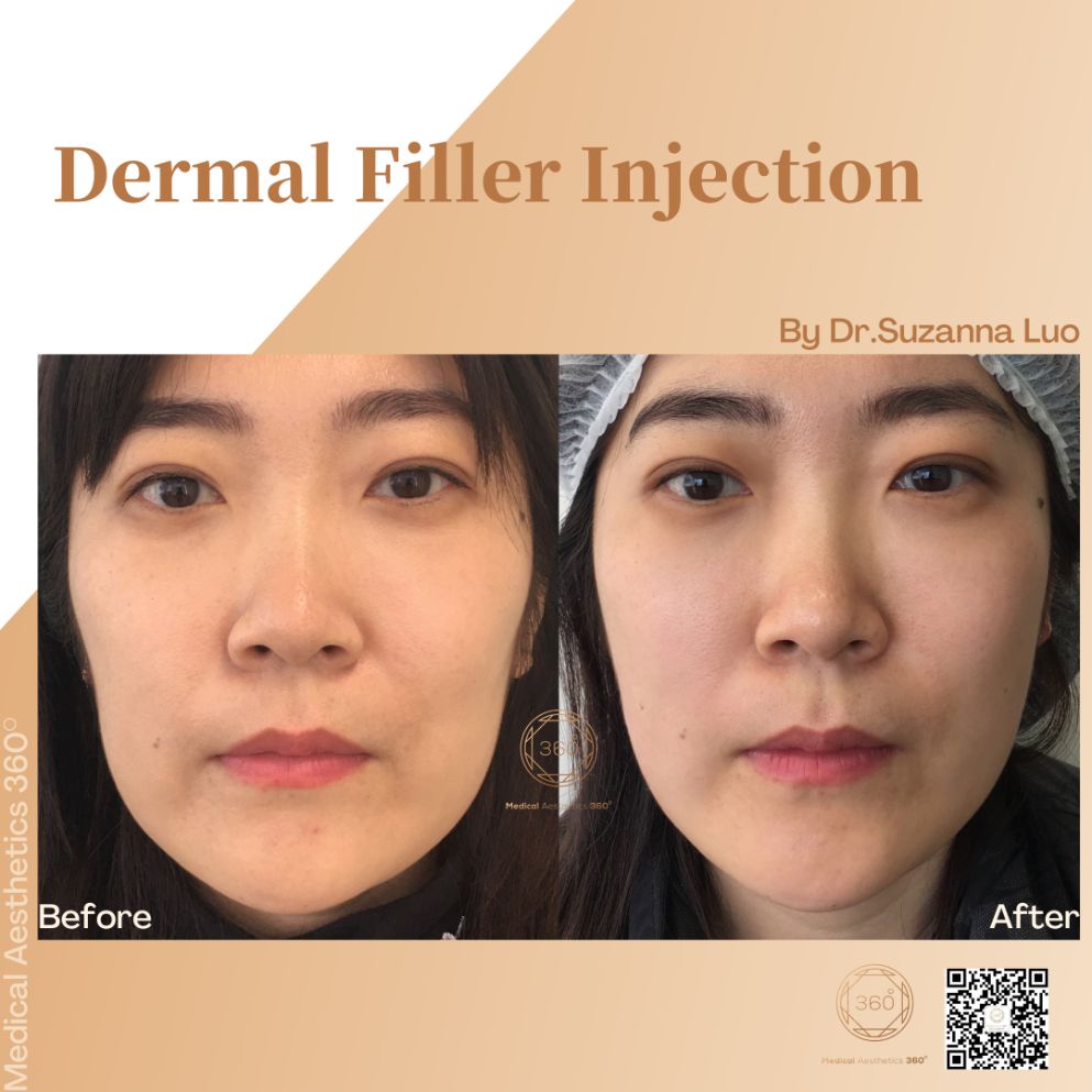 Dermal Fillers Injection Before & After