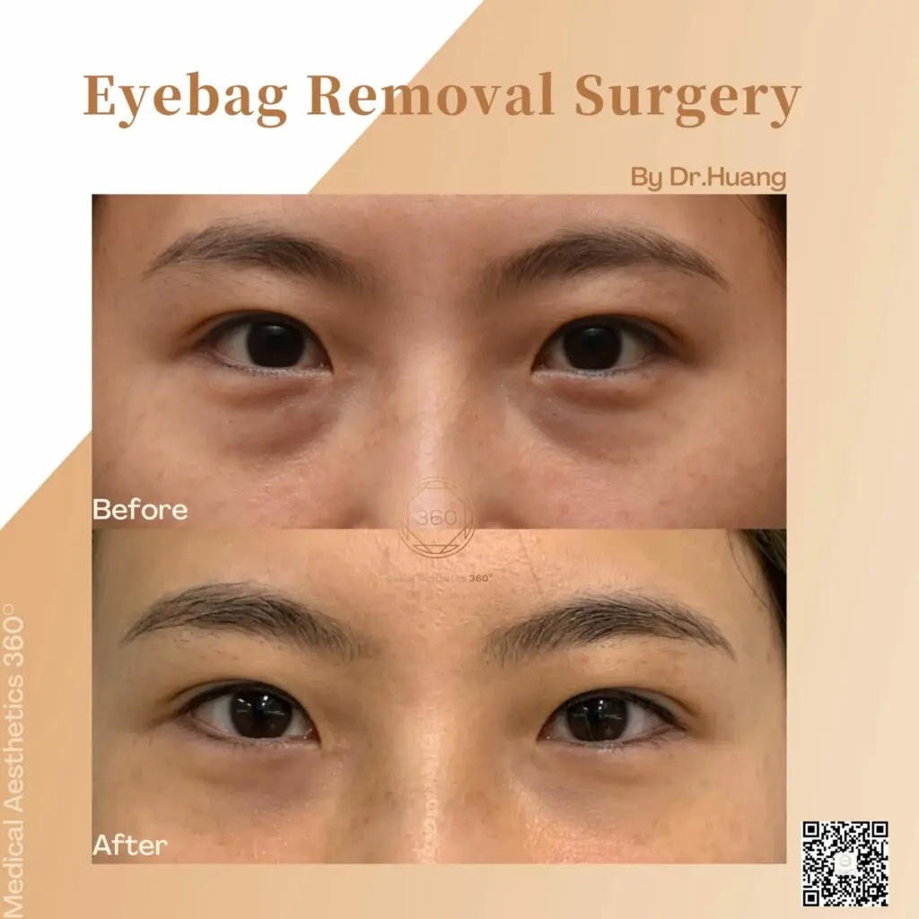 Eye Bag Removal Treatment Options in Singapore