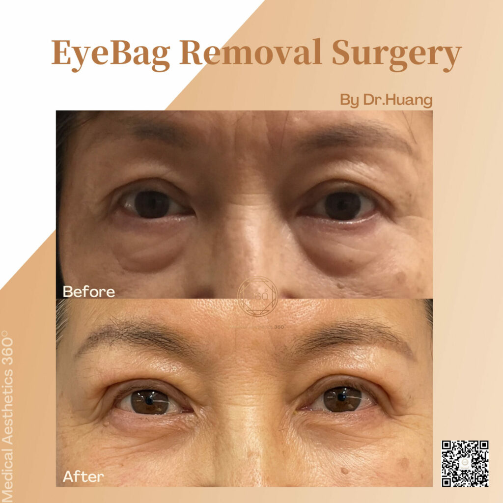 Best Transconjunctival Blepharoplasty Medical Aesthetics 360° 