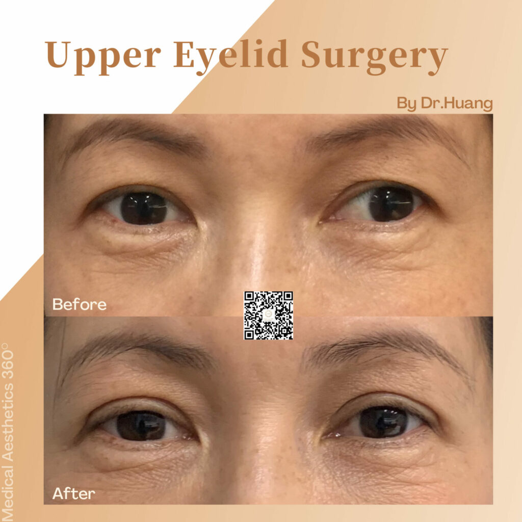 Upper Eyelid Surgery Before and After