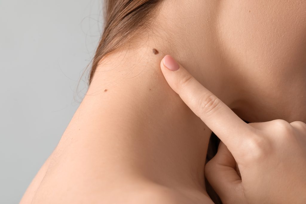 Skin Tag Removal Sydney
and Mole Removal Sydney