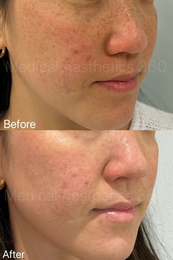 Laser Treatment for Pigmentation & Skin tone