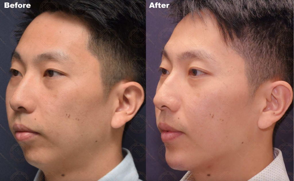 Chin and Lower-Face Sculpting Sydney