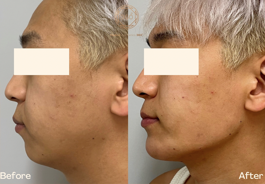 Chin and Lower-Face Sculpting Sydney