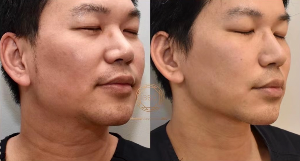 Chin and Lower-Face Sculpting Sydney