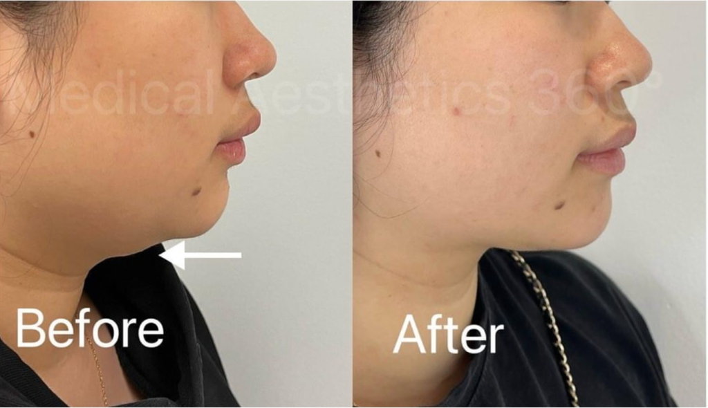 Chin and Lower-Face Sculpting