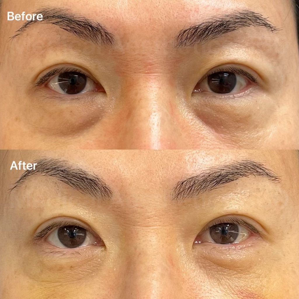 eyebag removal sydney
