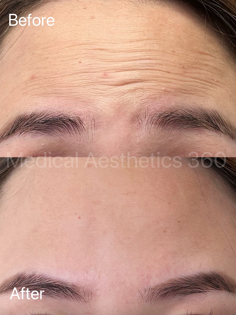 forehead wrinkle reduction Sydney