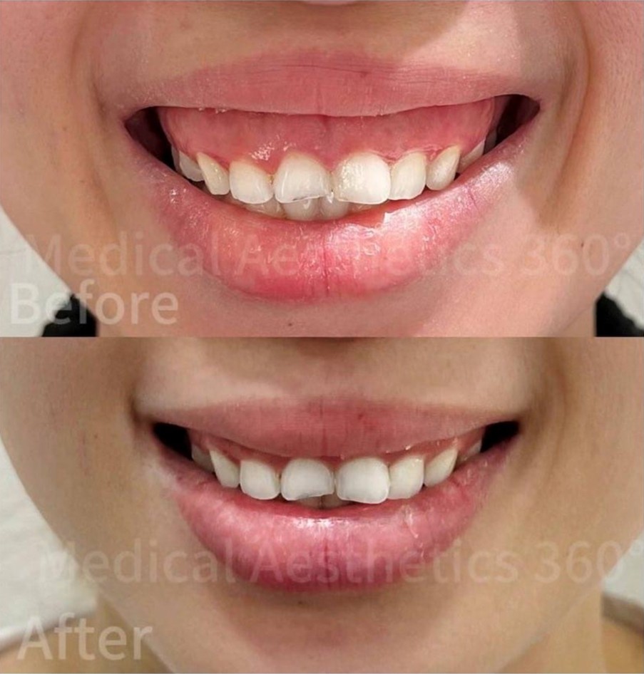 gummy smile treatment