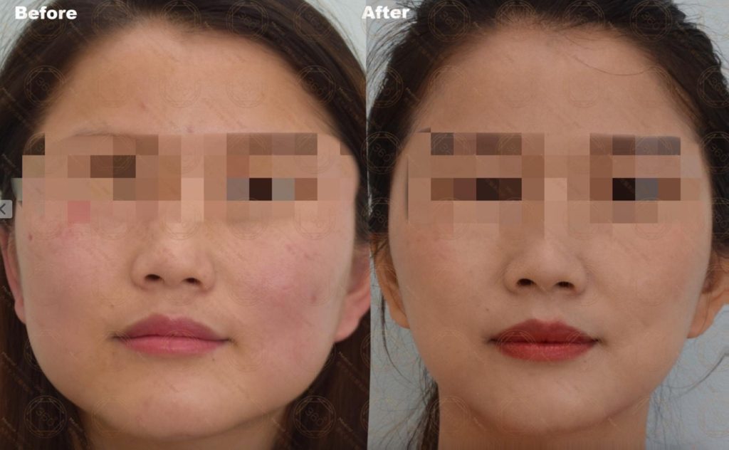 Refining Facial Shape While Easing Jaw Tension