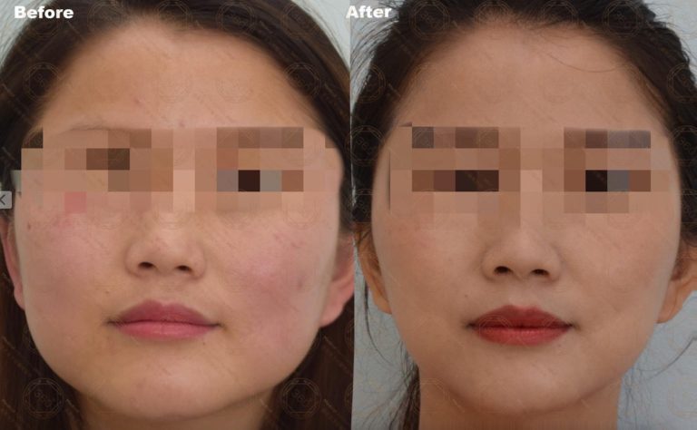 Refining Facial Shape While Easing Jaw Tension