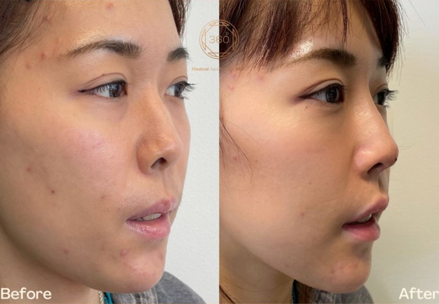 Refining the Nasal Bridge