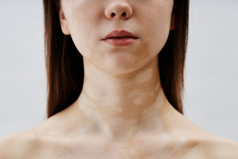 pigmentation treatment sydney