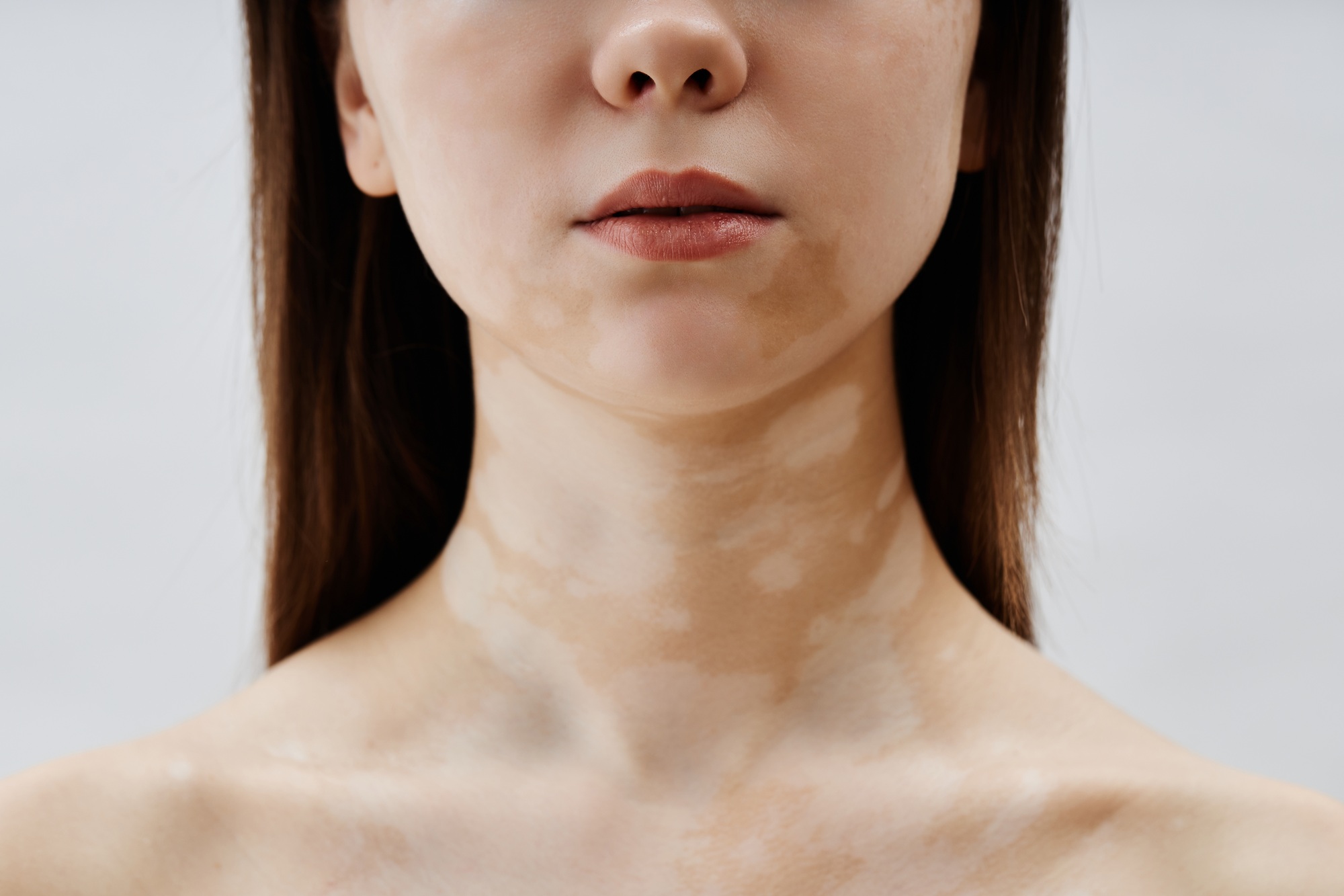 pigmentation treatment sydney