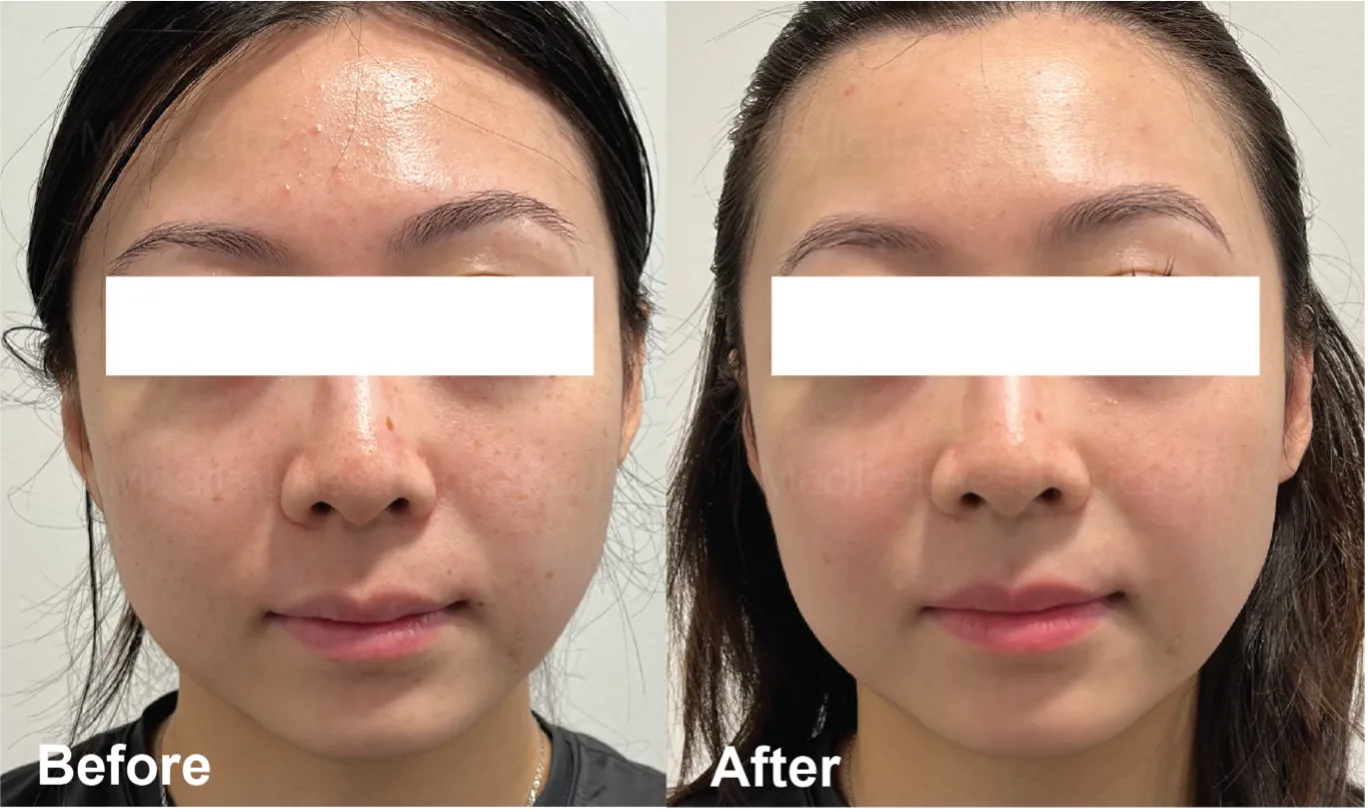 Before and after Sciton BBL treatment example for facial tone and pigmentation