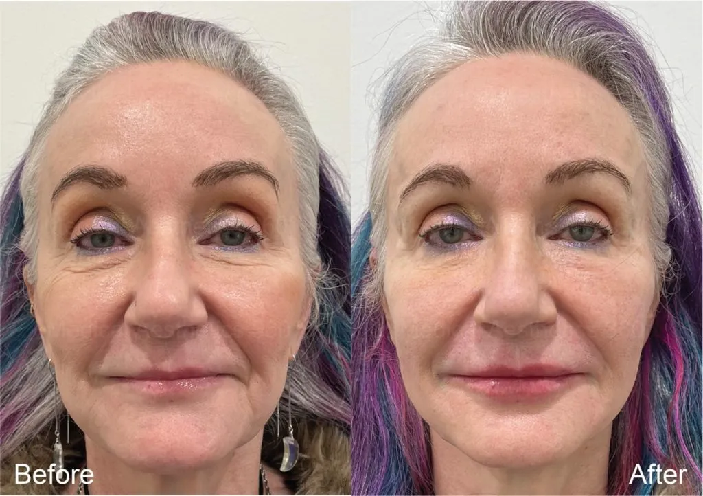 From Hollow to Harmonious — A Beautifully Balanced Facial Renewal