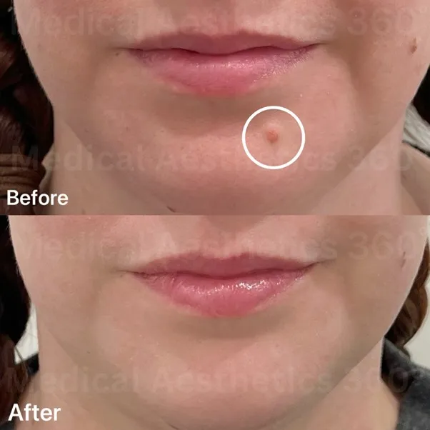 Chin mole removal before and after