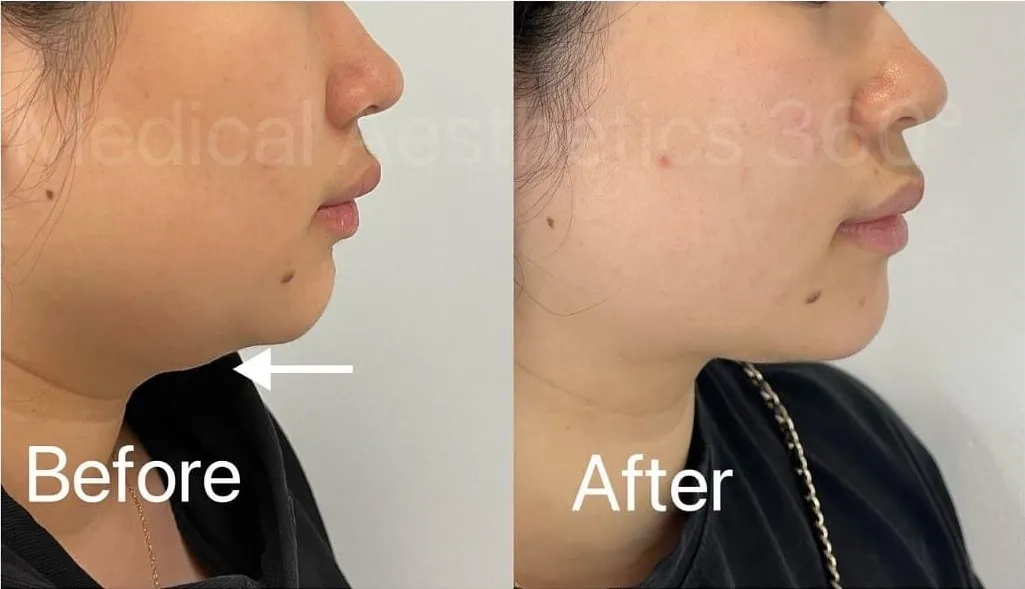 Double Chin Reduction – Defining the Health Journey