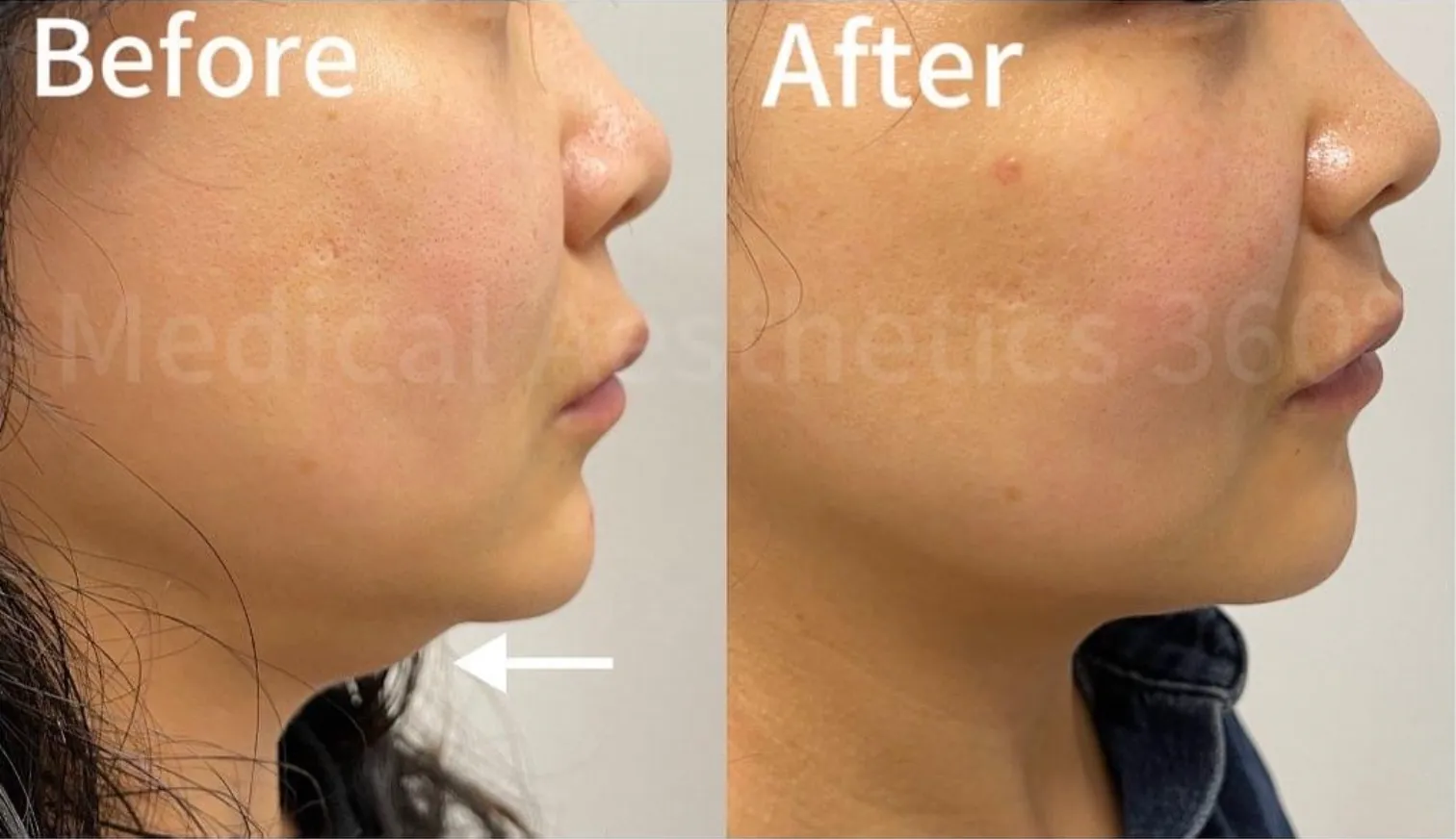 Double Chin Reduction for a More Defined Jawline