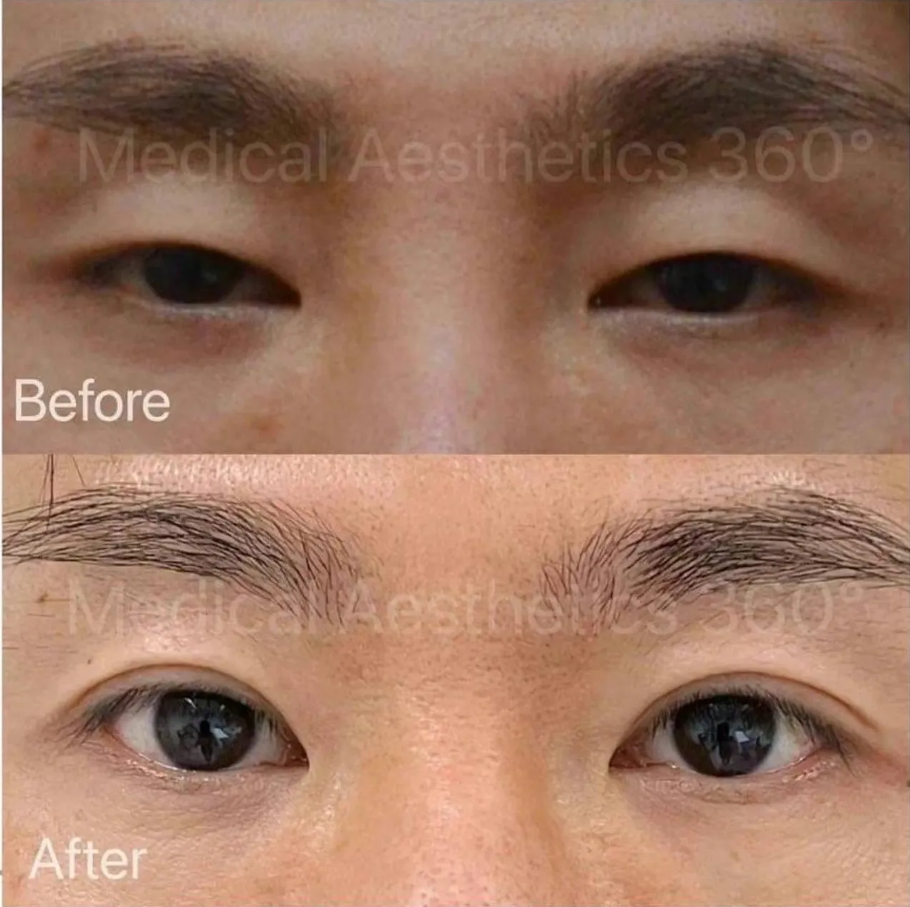 雙眼皮手術案例分享 3