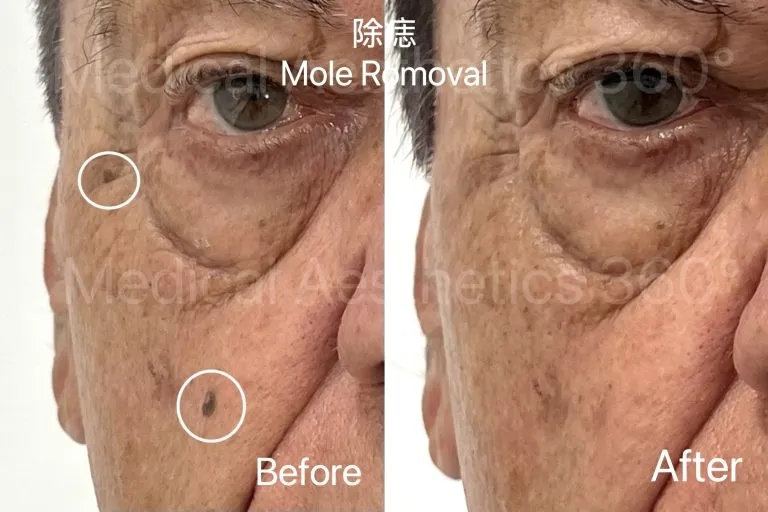 Facial mole removal before and after