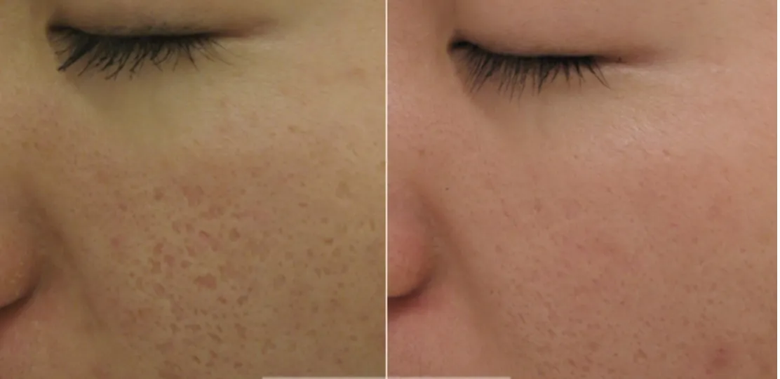 Fractional CO2 Resurfacing for Boxcar and Ice Pick Acne Scars in a 28-Year-Old Lady