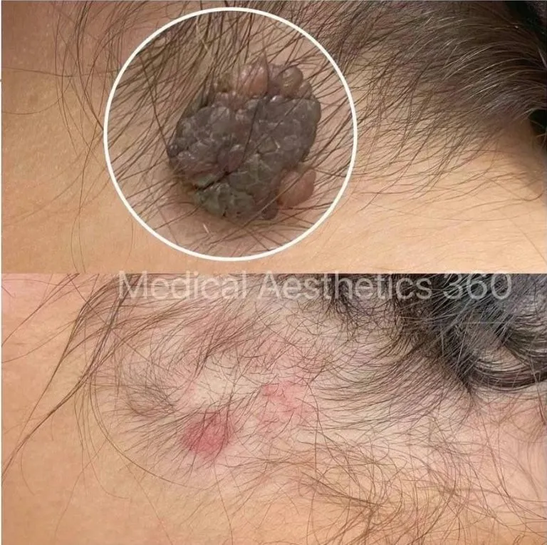 Hairline lesion before and after removal