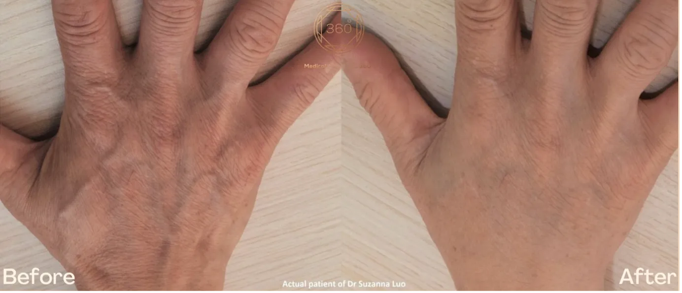 Hand rejuvenation treatment image showing refreshed hand appearance