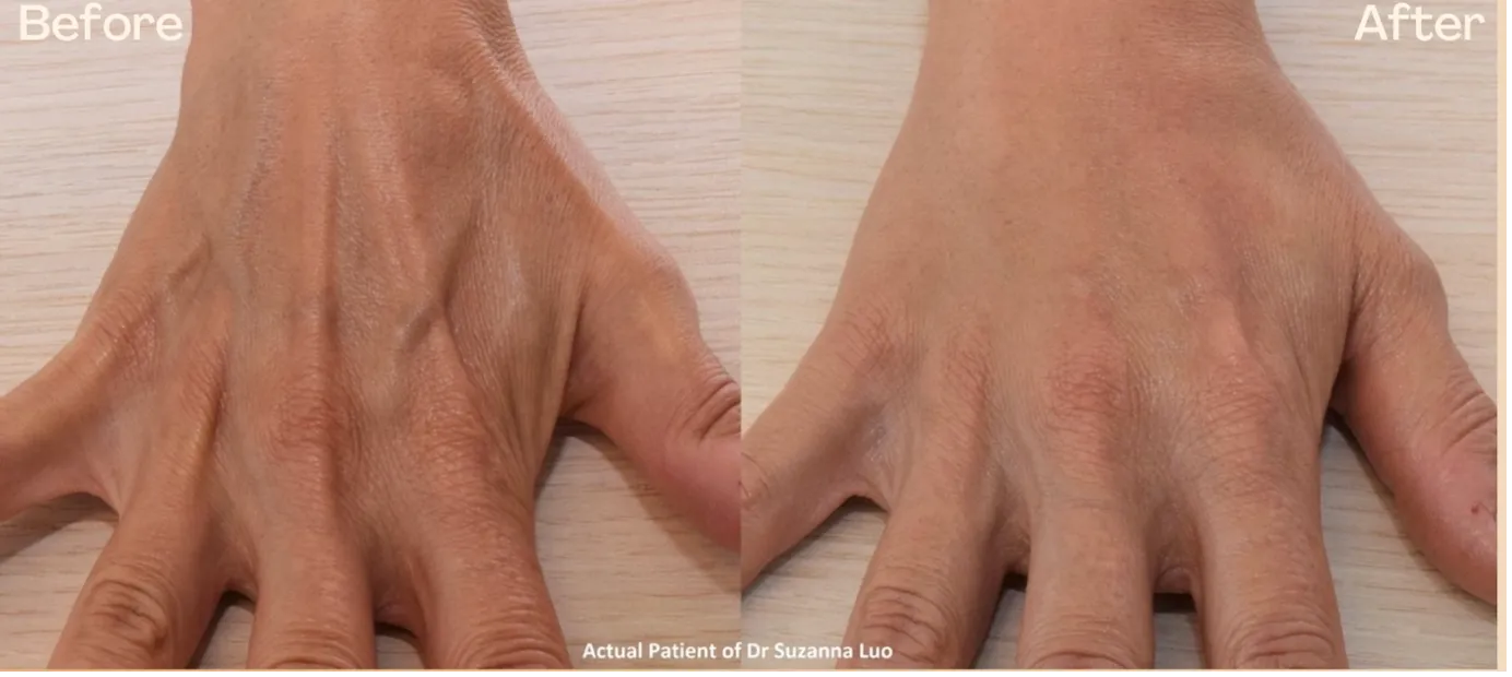 Hand rejuvenation treatment result at Medical Aesthetics 360