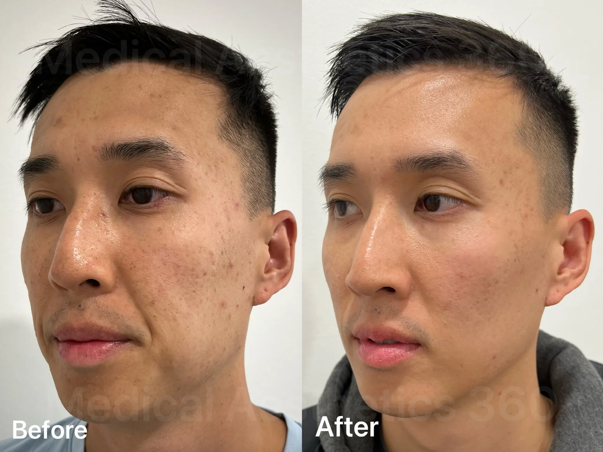 悉尼 Medical Aesthetics 360 魔力微針 | Morpheus 8 療程前後對比