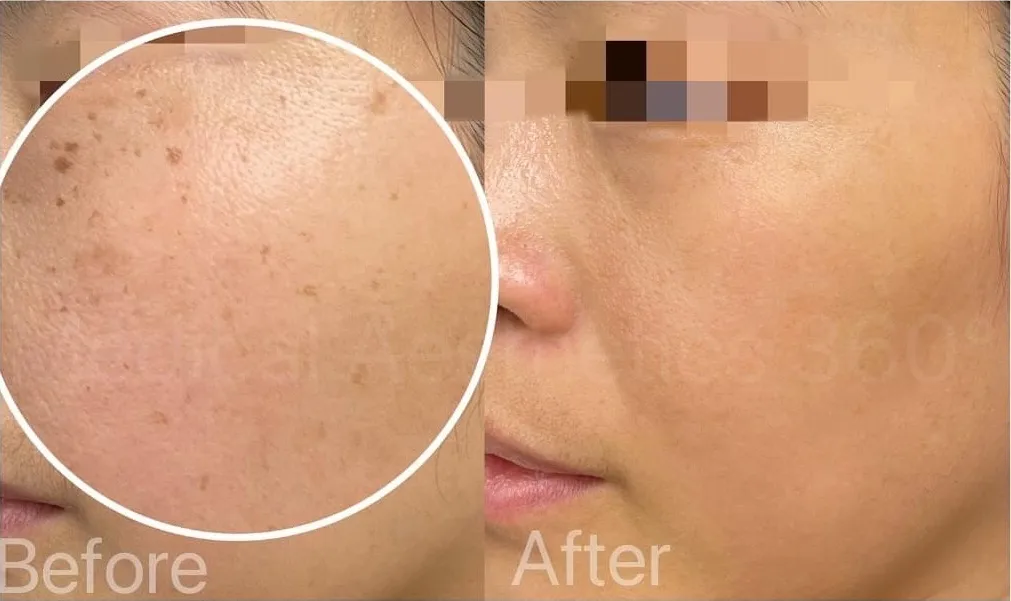 Pigmentation and uneven skin tone assessment example at MA360