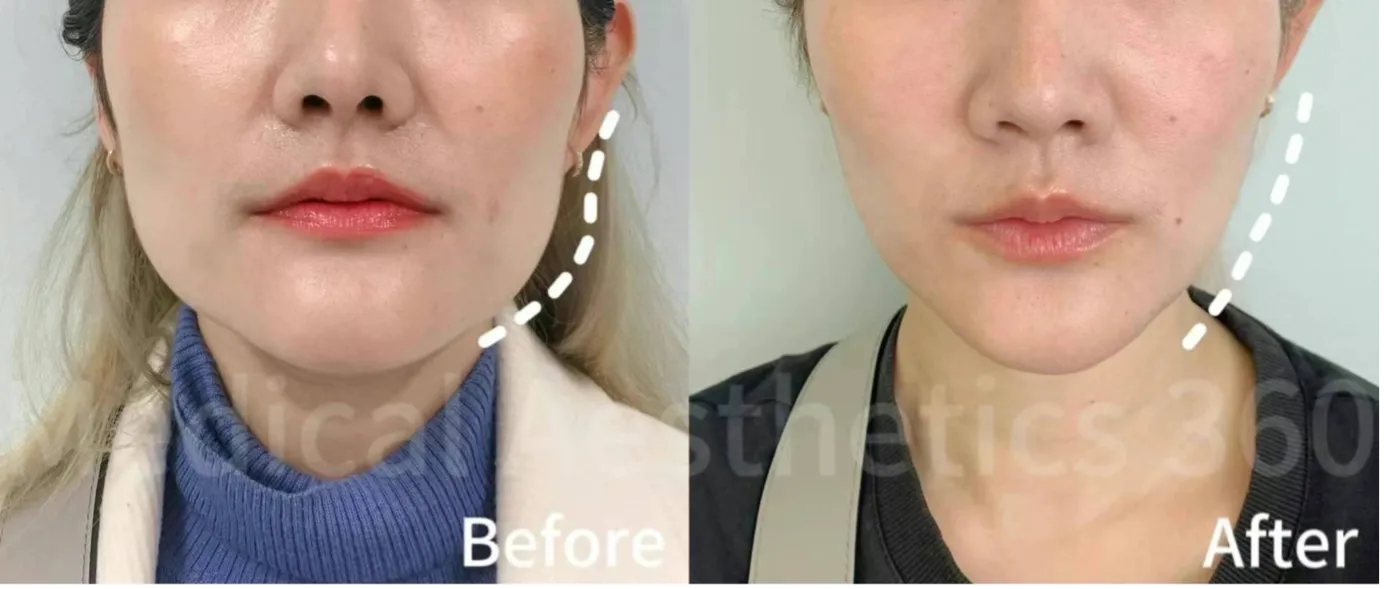 From Jaw Tension to a Softer Profile: A Face Slimming Journey with Functional Relief