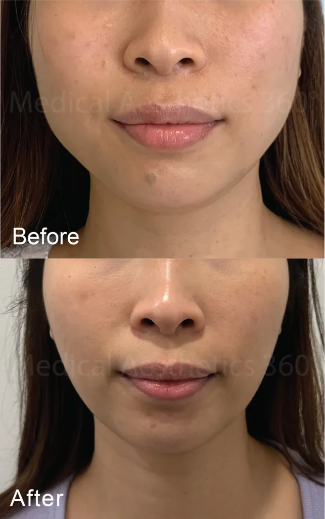 Jawline Softening & Relief from Teeth Grinding