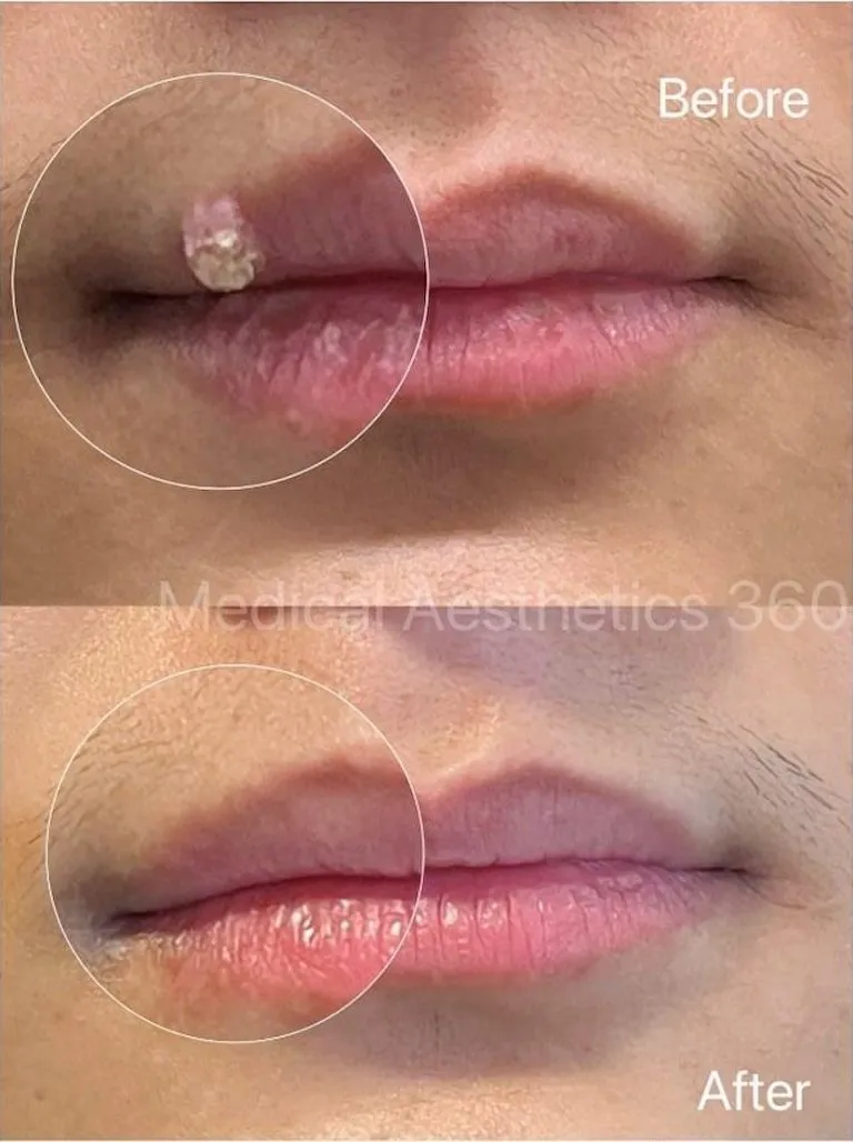 Lip growth before and after removal