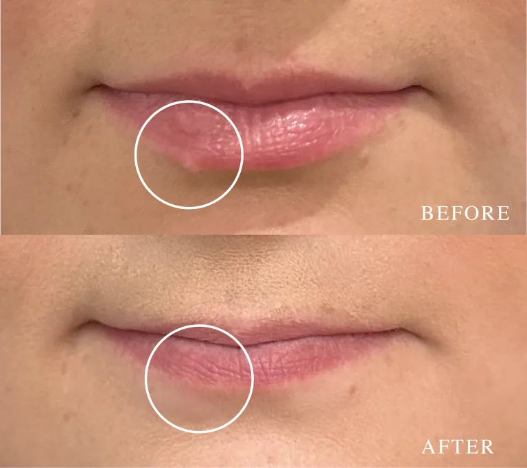 Lip line mole removal before and after