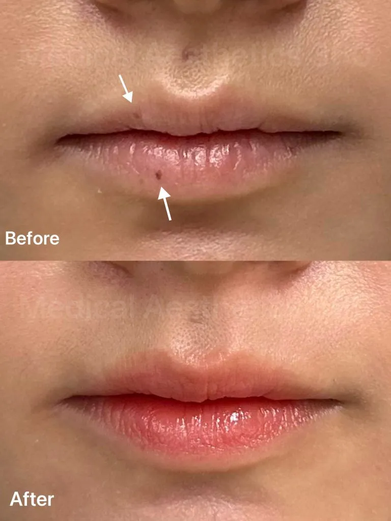 Lower lip mole removal before and after