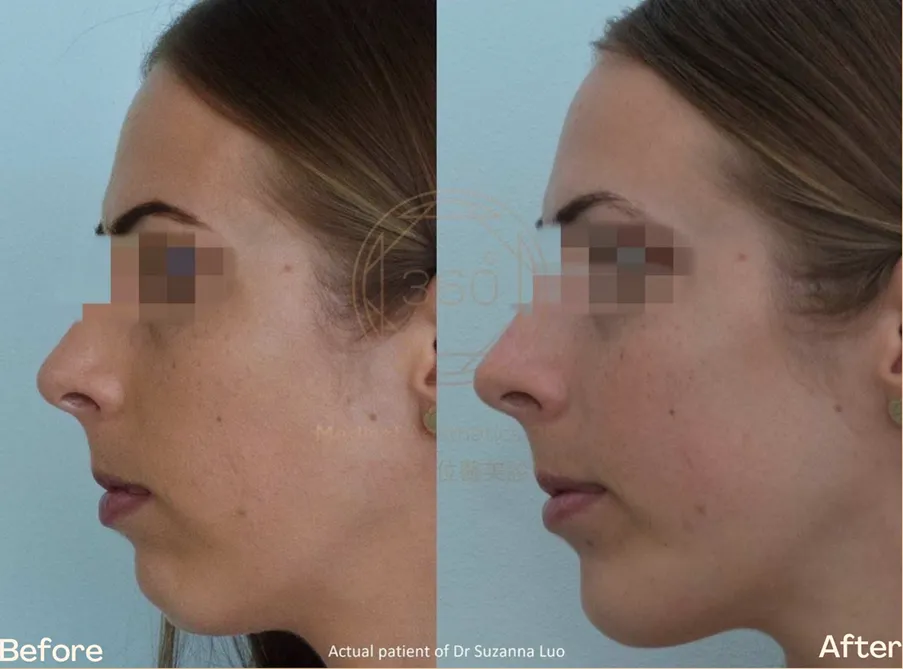 A More Defined Chin, A More Balanced Profile: Subtle Projection with Natural Facial Harmony