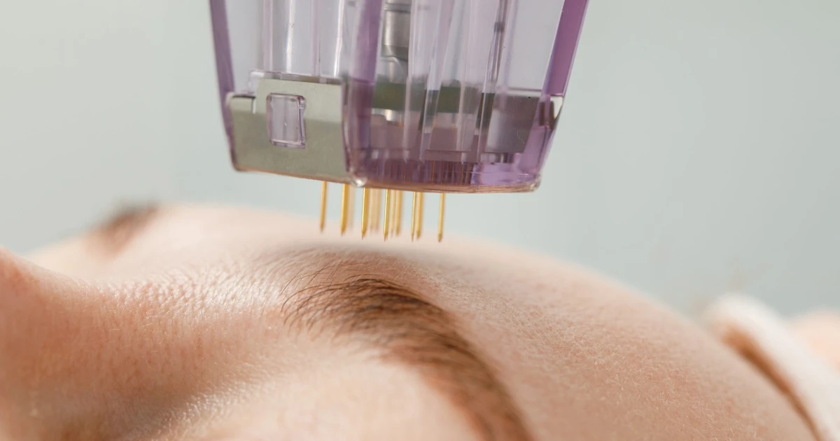 Medical Aesthetics 360 悉尼醫生主導 Morpheus 8 射頻微針療程