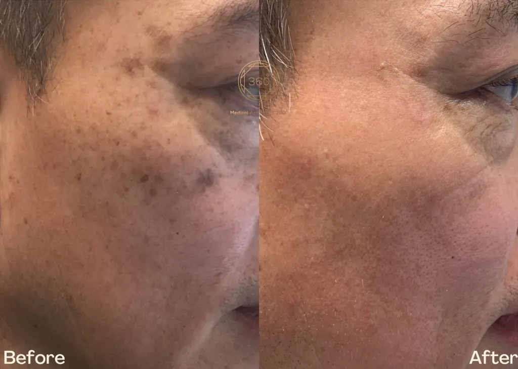 Before and after PicoSure treatment example for facial pigmentation