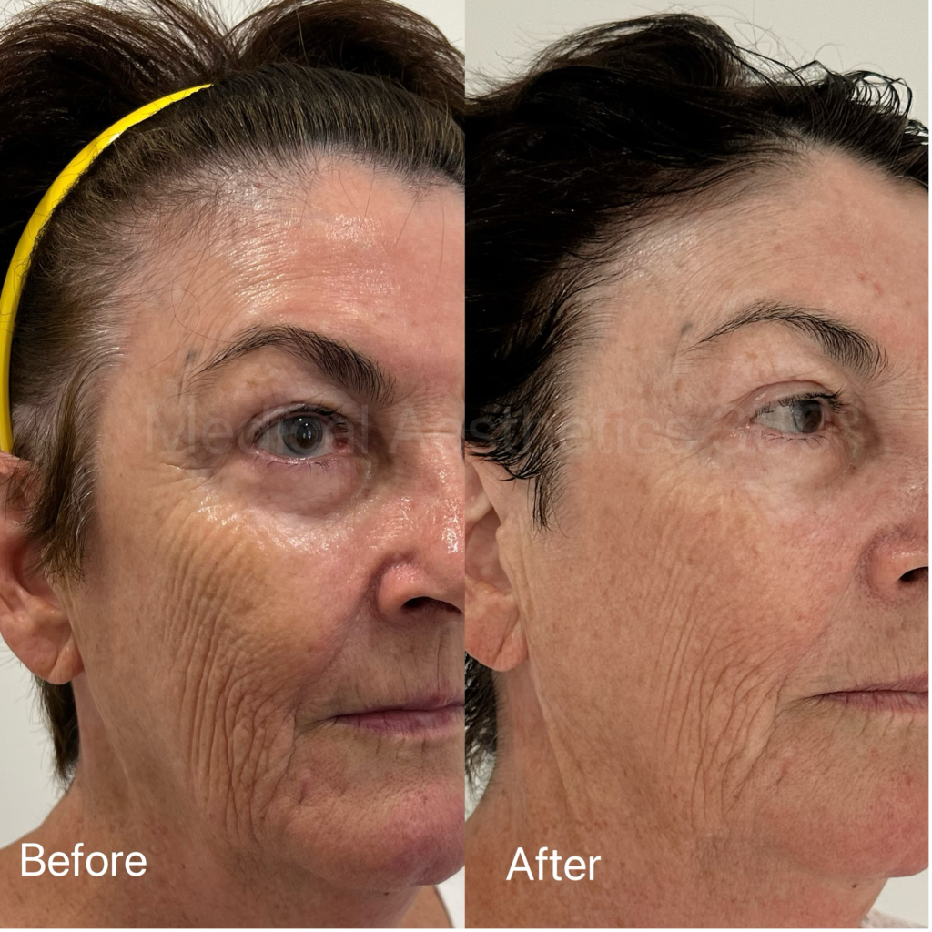 Side-by-side comparison of a woman’s face showing reduced facial wrinkles and smoother skin after treatment.