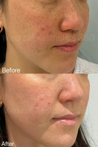 From Uneven to Radiant — Laser Treatment for Pigmentation & Skin tone