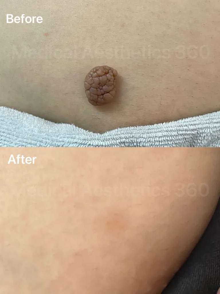 From Irritated to Invisible — Precision Erbium Laser Skin Tag Removal