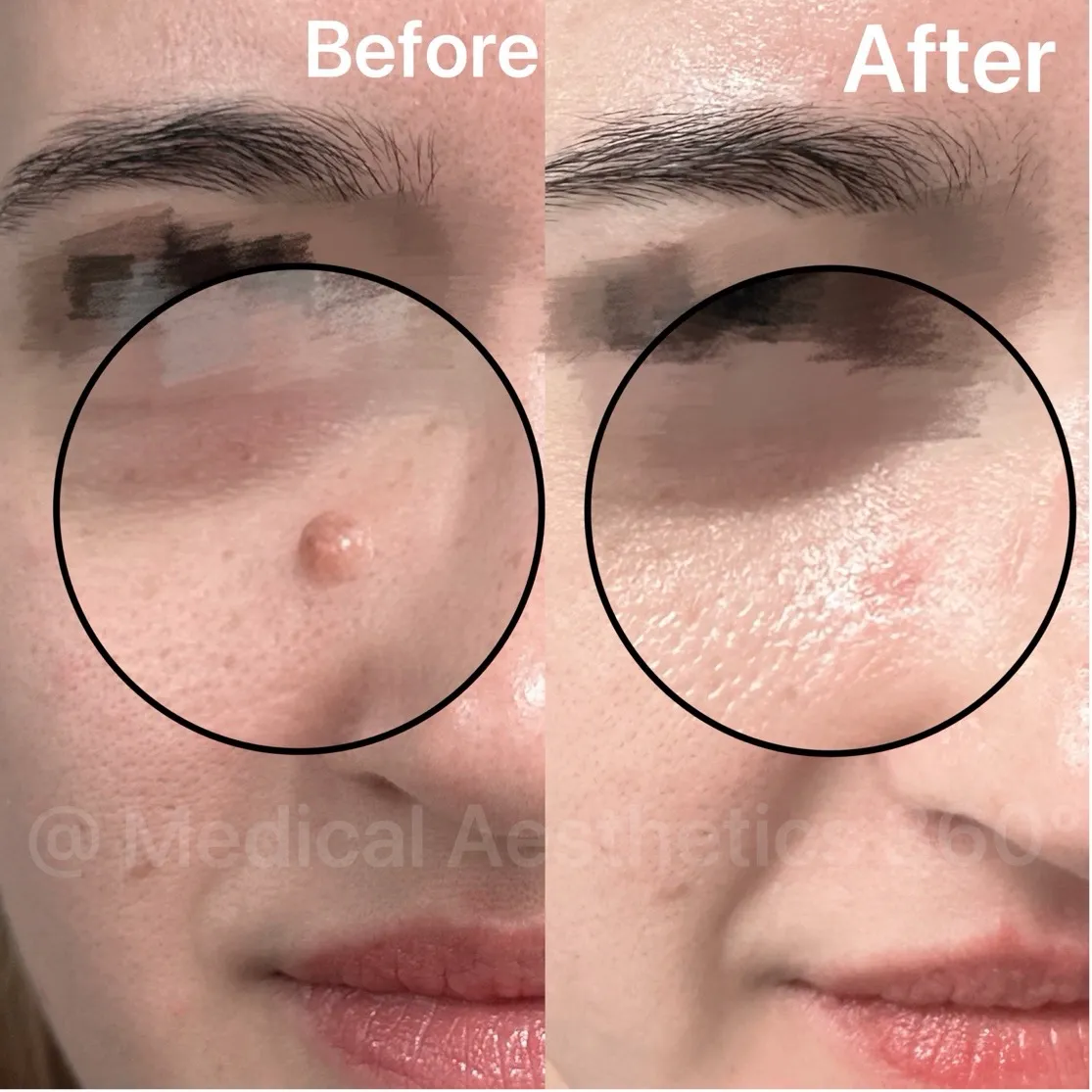 Clear, Smooth Skin Again — Precision Mole Removal in Sydney