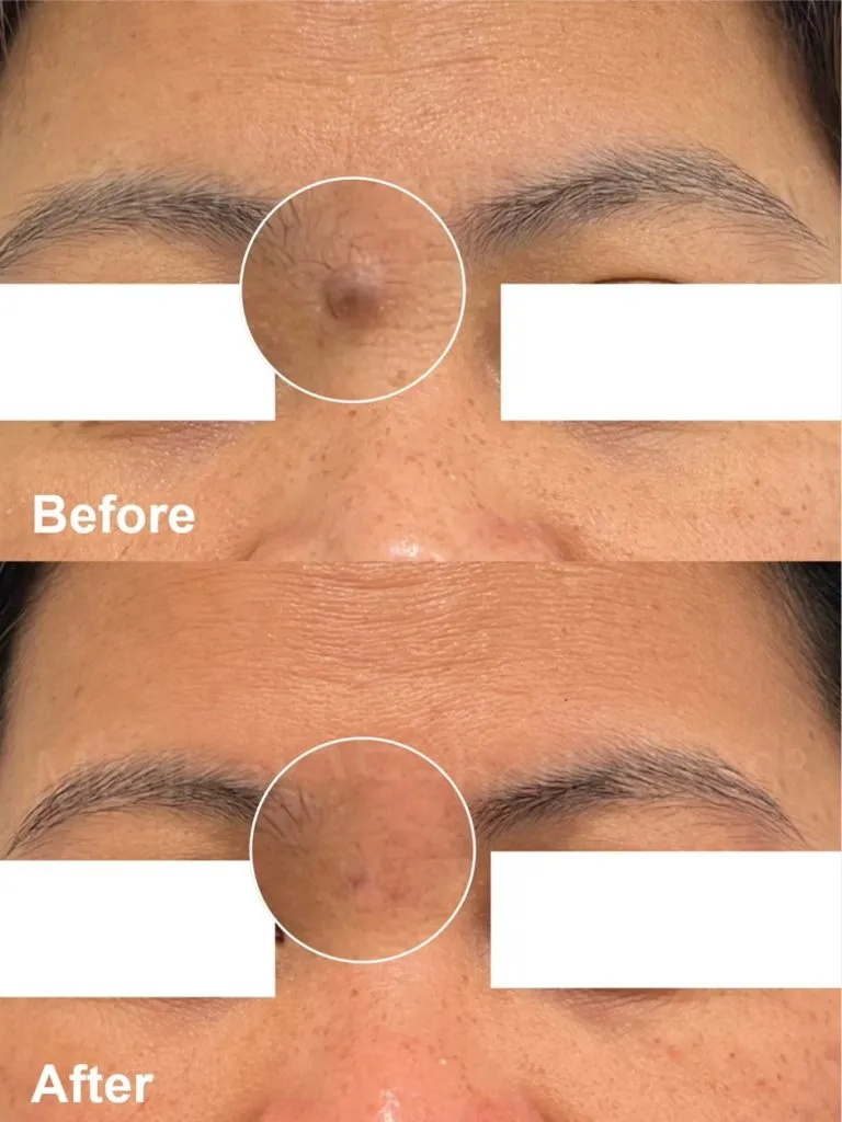 Raised mole removal before and after