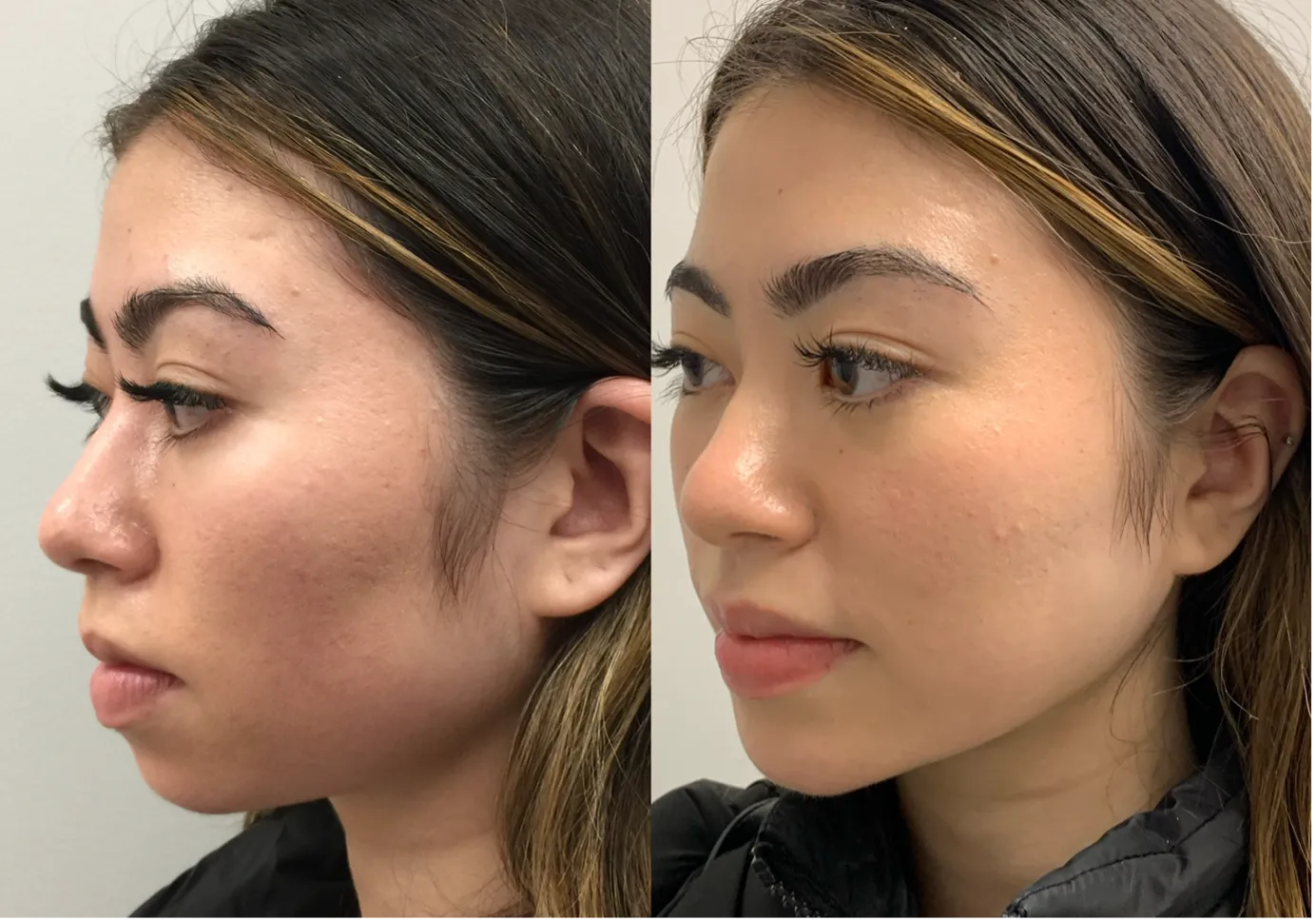 Chin profile and lower-face proportions assessed at Medical Aesthetics 360 Sydney
