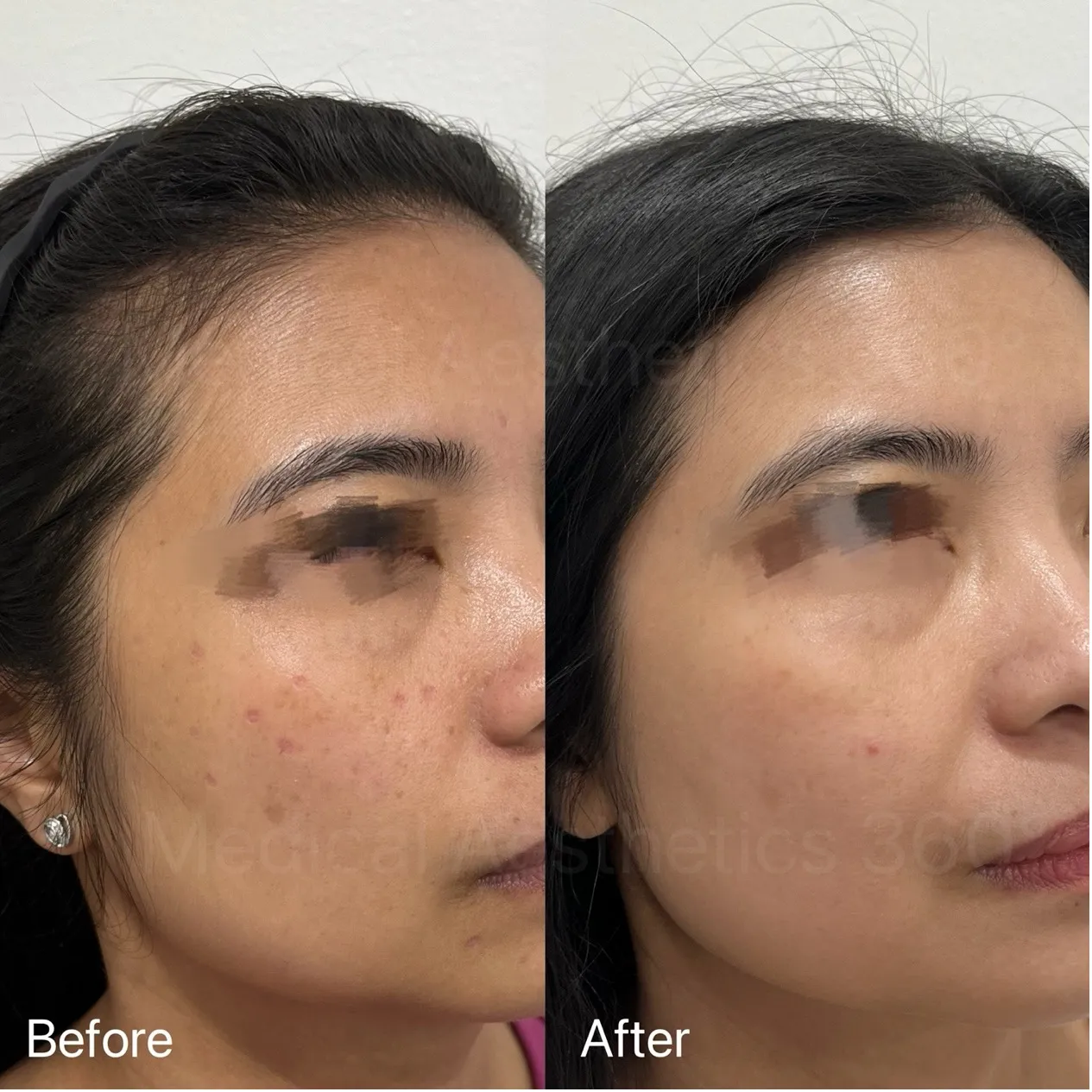 From Scars to Smooth, Scar and Pigment Treatment for Healing Skin